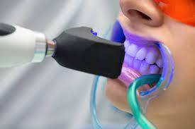 Professional teeth whitening treatment for a bright smile at Master of Dent